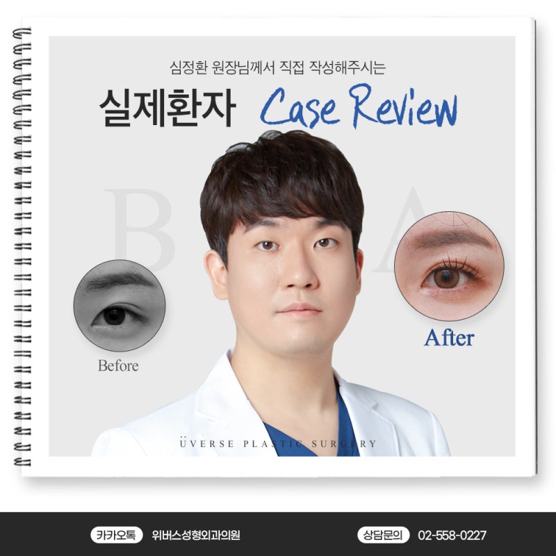 자연유착(진피유착) 쌍꺼풀 실제 케이스 리뷰 - 풀린 눈 비대칭 교정