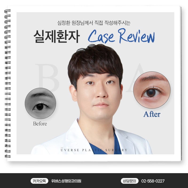 자연유착·눈매교정·눈두덩이 지방이식 실제 케이스 리뷰